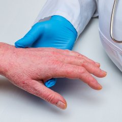 A doctor in gloves examines the skin of the hand of a sick patient. Chronic skin diseases - psoriasis, eczema, dermatitis.